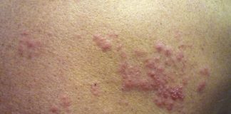 한의학으로 치료하는 통증의 왕 ‘대상포진’