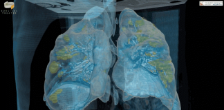 코로나19 감염 중증환자 폐 VR 모델