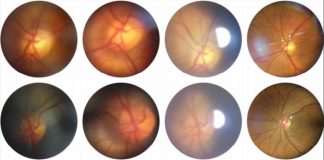 “스마트폰 카메라로 망막 진단한다”